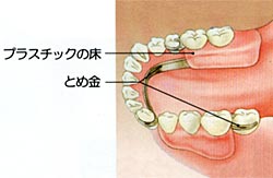 インプラントは水野歯科クリニック　従来の入れ歯